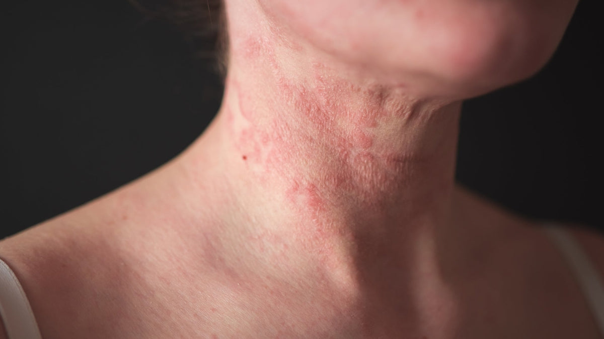 Eczema Skincare Solutions