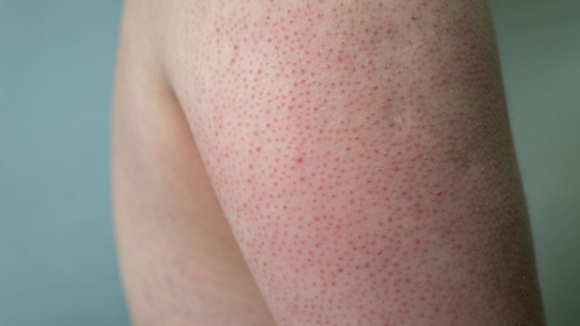 How to Treat Keratosis Pilaris