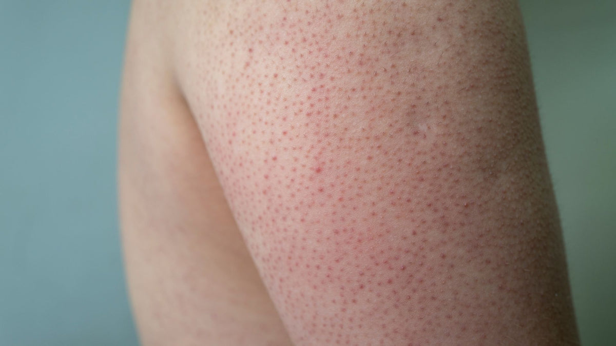 How to Treat Keratosis Pilaris