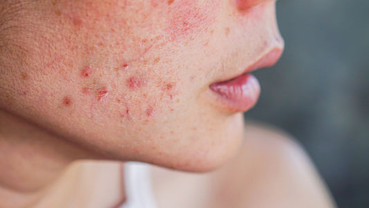 Breakouts uncovered: Essential things you should know about acne treatment