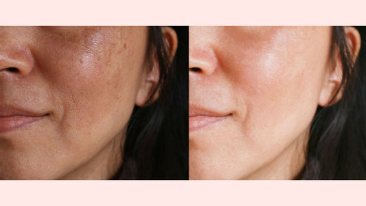 How to treat skin discoloration