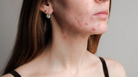 How to successfully treat hormonal cystic acne