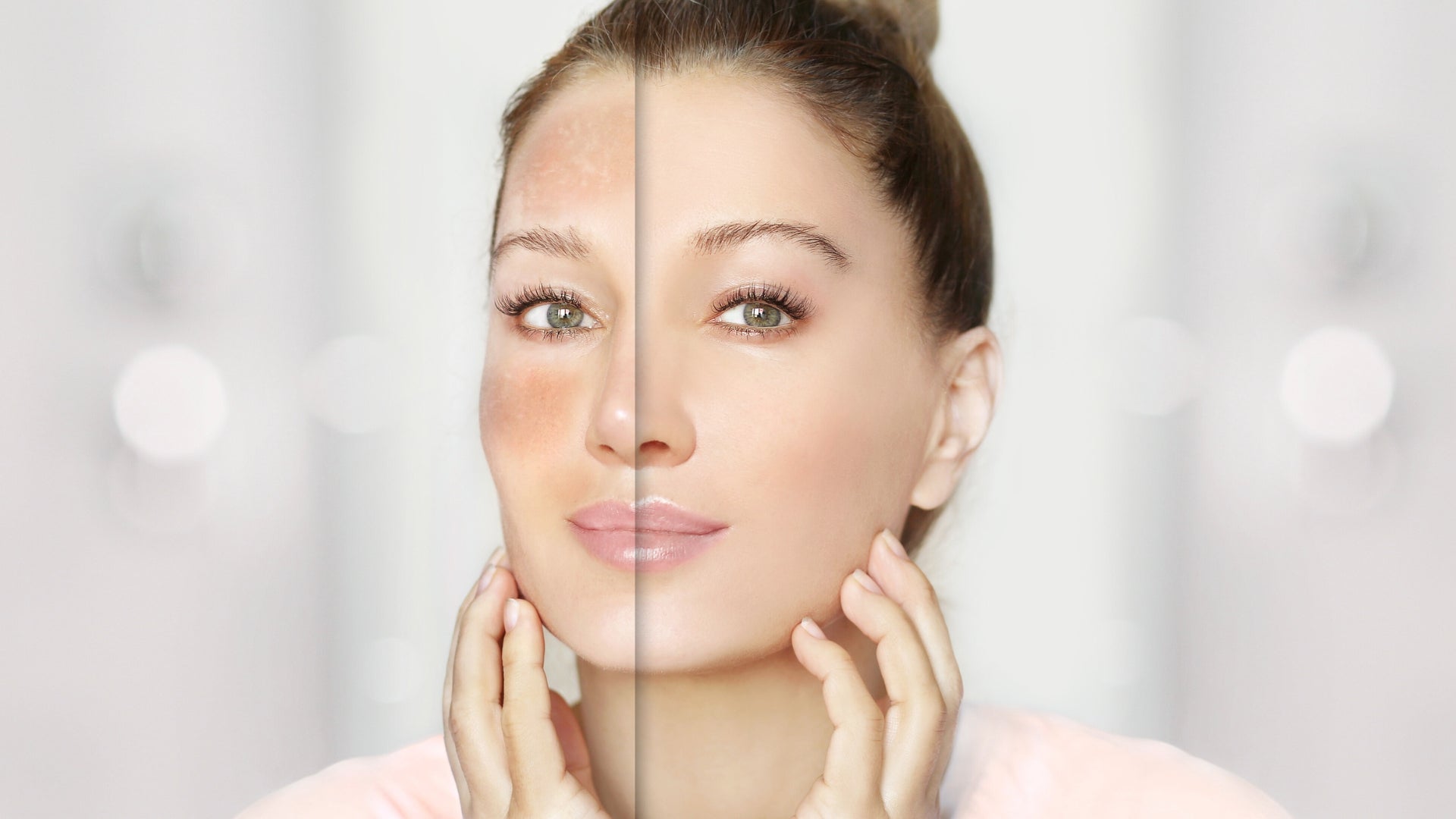 Melasma Treatment That Works