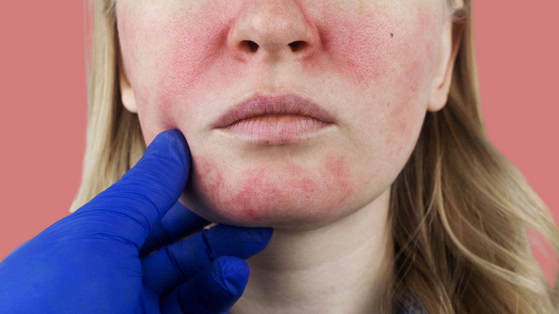 Navigating Rosacea