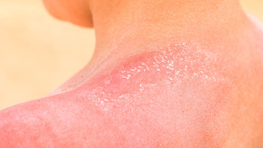 The do's and don'ts of sunburn care: Tips for fast relief and prevention of further damage