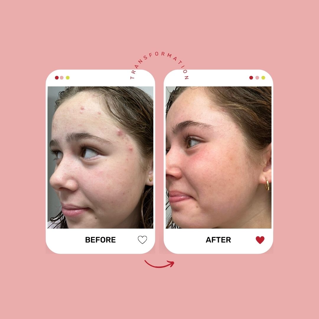 Teen Skincare 101 Course