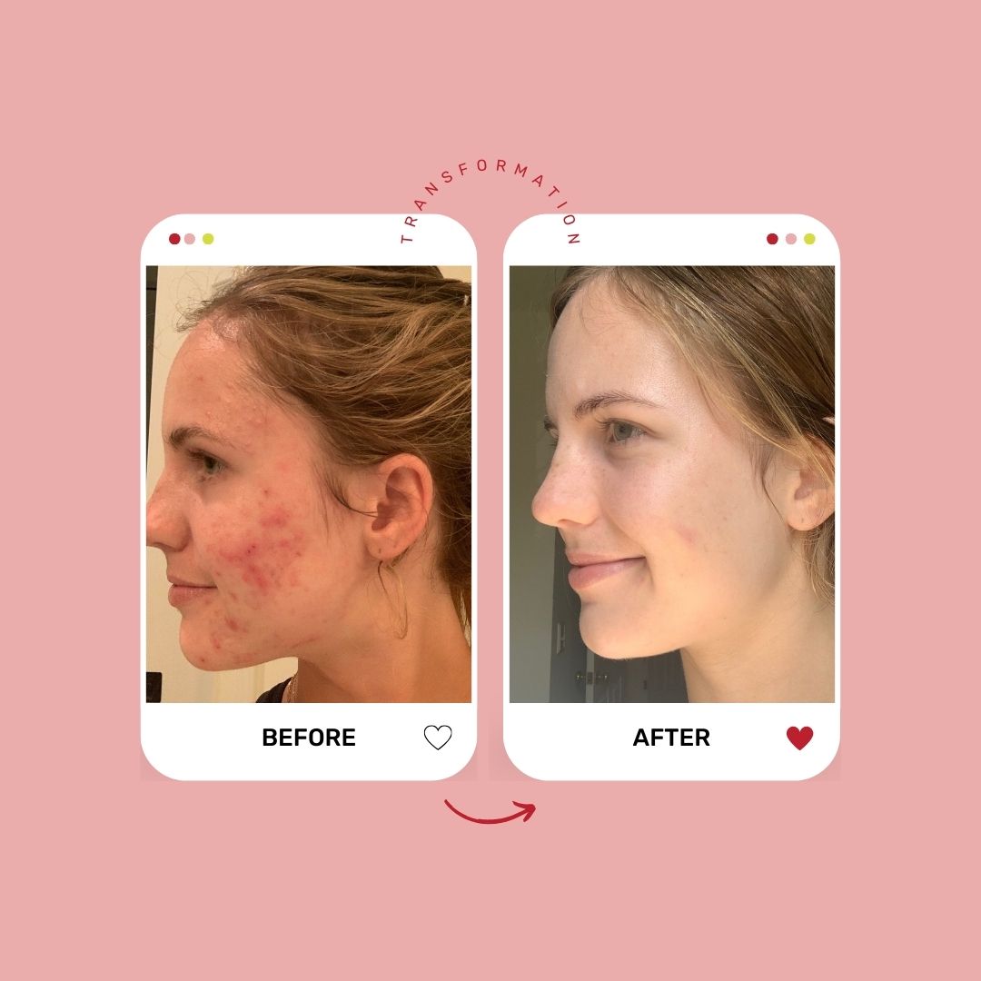 Teen Skincare 101 Course