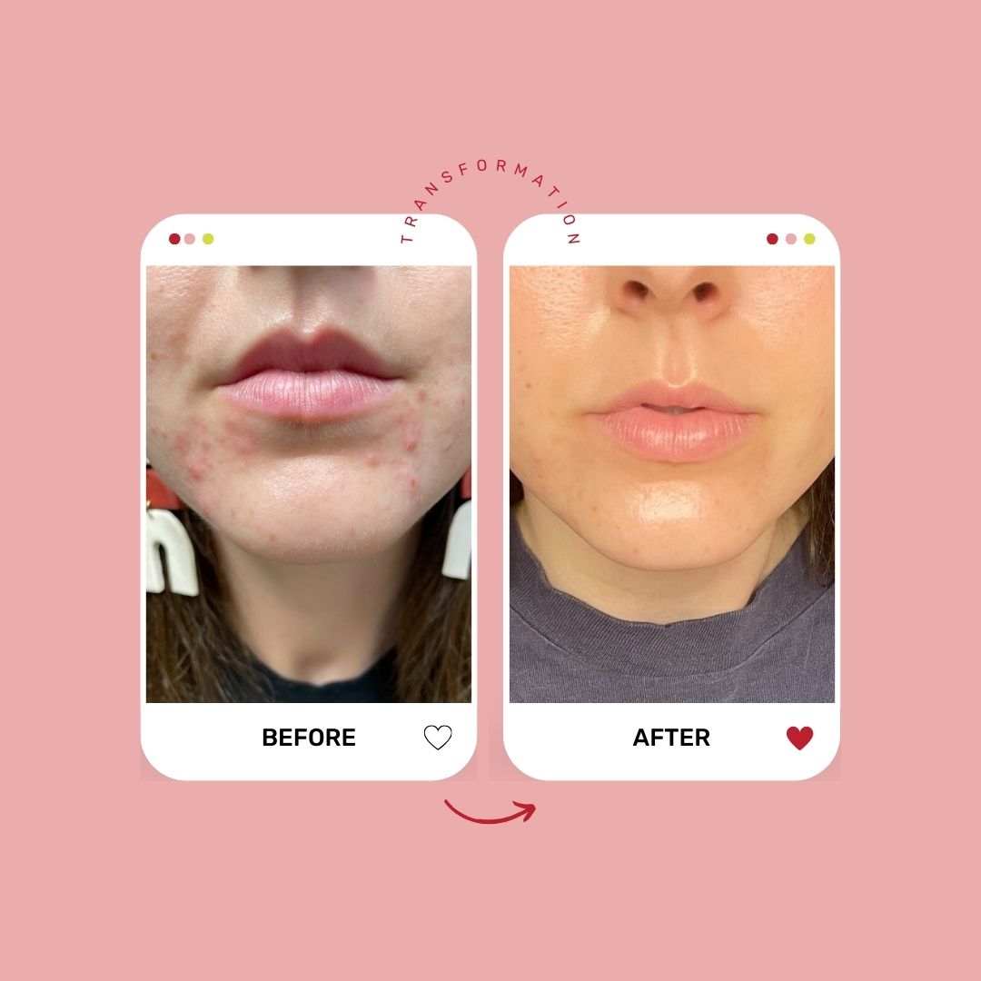 Teen Skincare 101 Course
